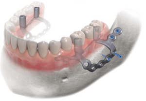 Dentsmile srl, partner ufficiale di Eaglegrid, un protocollo innovativo che consente di inserire gli impianti dentali anche nei casi di atrofia ossea più complessi.